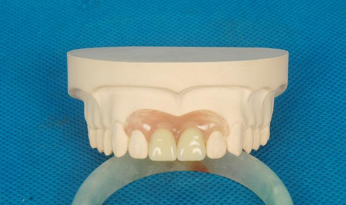 Meharry Valplast Parital mn408